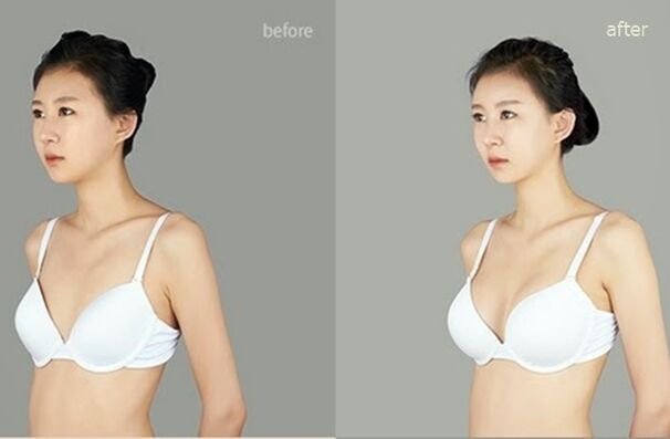enne ja pärast plastilist rindade suurendamist