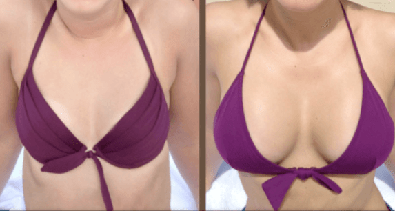 Enne ja pärast rindade suurendamise operatsiooni