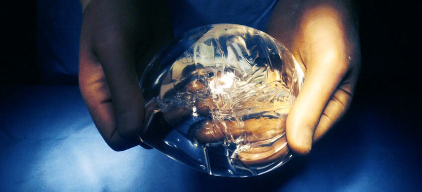 Silikoon endoprotees