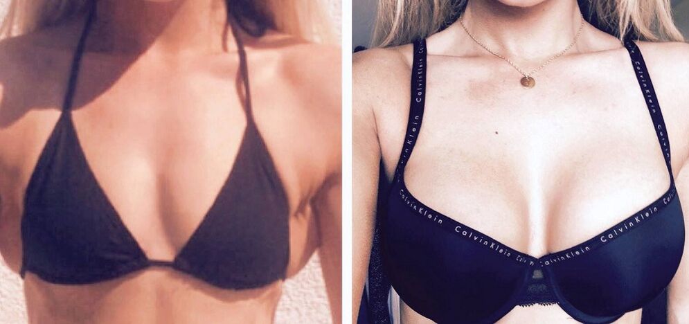 Enne ja pärast rindade suurendamist